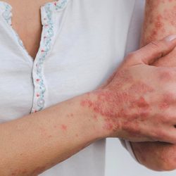 Lesiones cutáneas características de la psoriasis, una enfermedad inflamatoria crónica de la piel relacionada con la activación excesiva del sistema inmunitario. Foto cedida por la investigadora Eszter Miller-Pixabay